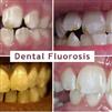فلوراید زیاد موجب تغییر رنگ دندان ها میشود